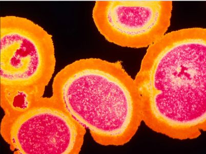 MRSA under microscope red, orange, yellow